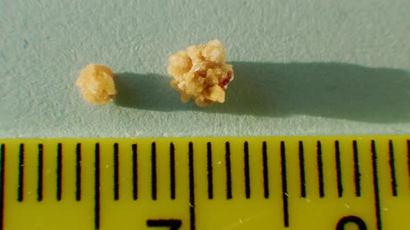 Oxalate Stones From The Human Kidney Close Up, Phosphate Or Urate Calculus In Human Kidney 4 Mm.