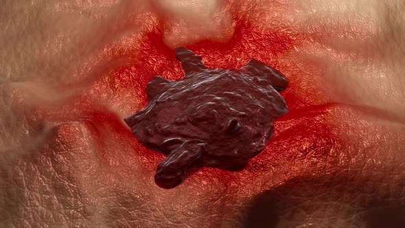 A growing Skin cancer 3D animation