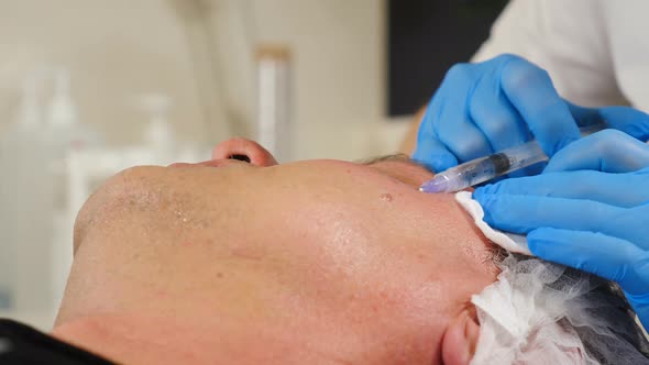 Beautician Applies Serum or Mesococtail to Male Face Performing Mesotherapy Procedure alt