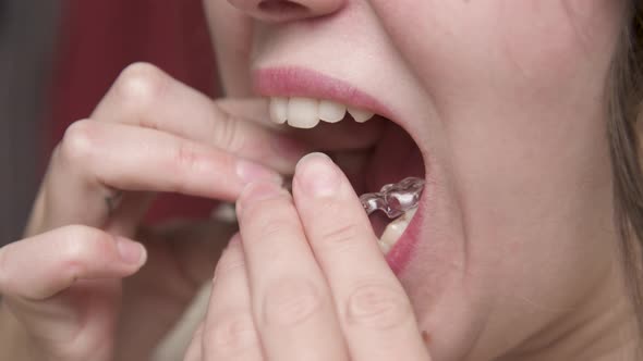 Mouth Closeup A Young Woman Puts a Corrective Aligner Splint on Her Lower Teeth to Correct an alt