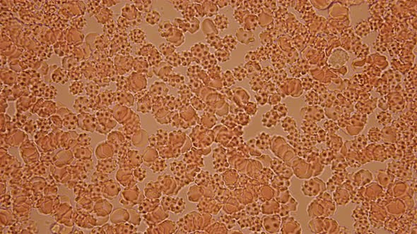 Blood Under a Microscope, the Movement of Spur-shaped Red Blood Cells, Which Indicates a Human alt