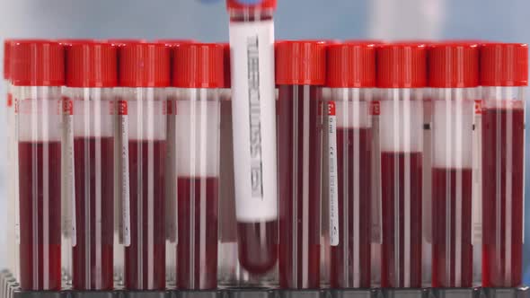 Hand Wearing Protection Glove Puts Vial with Tuberculosis Test alt