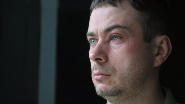 Sick Man with One Annoyed Red Blood Eye with Symptom of Conjunctivitis alt