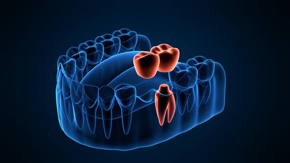 Jaw with dental cantilever bridge placement on dark blue background