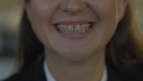 Close-up Toothy Smile of Young Caucasian Woman Wearing Dental Braces. Unrecognizable Positive alt