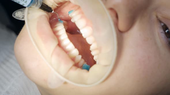 Dentist Applying Whitening Gel on Patient's Teeth in Modern Dentistry