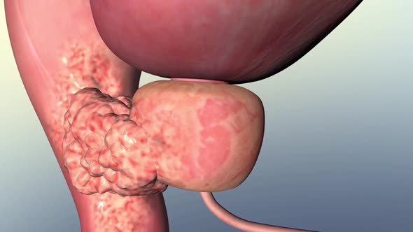 Prostate cancer tumor growth alt