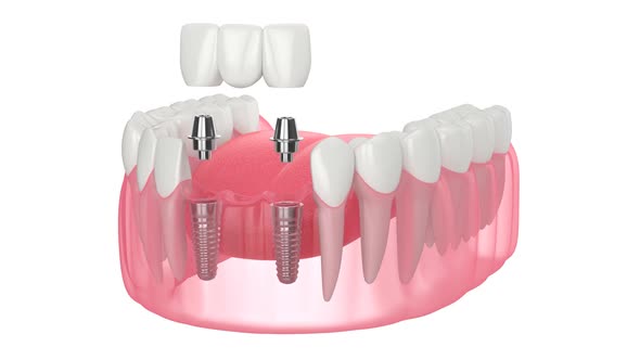 Jaw with implants supporting dental bridge over white background