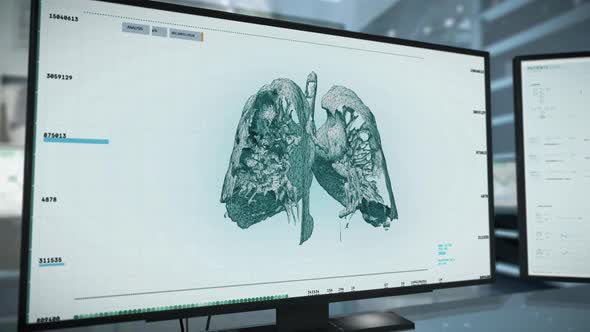 Patients Lung Organ Pneumonia Disease Treatment Applying High Tech MRI Scan alt