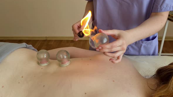 Acupuncturist Heating a Cupping Bulb with Flame Vacuum Massage with Glass Jars