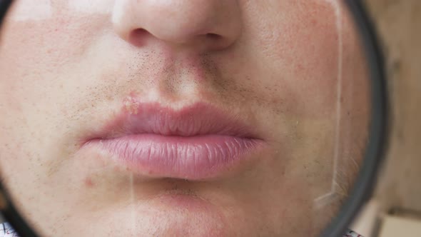 Herpes On The Lip Of A Man Through A Magnifying Glass, A Pimple On The Lip. Viral Herpes