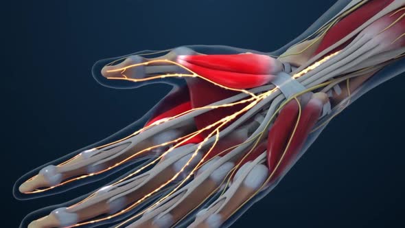 Carpal tunnel syndrome (CTS) condition of numbness, tingling, or pain in the wrist caused alt