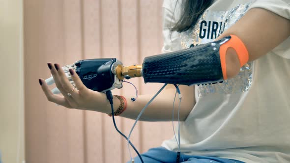 Robotic Limb, Prosthesis. Girl Use Bionic 3d Printed Arm for the First Time alt