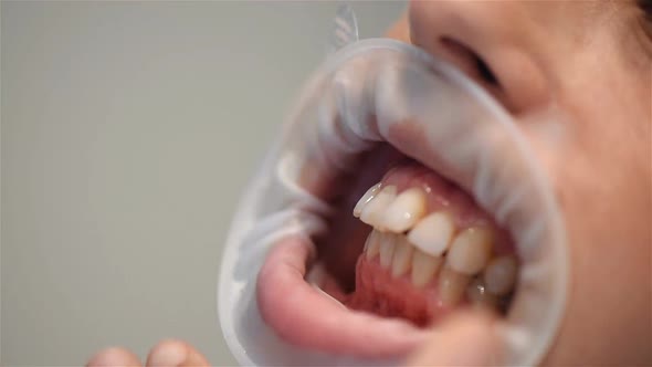 Patient Is Showing Teeth