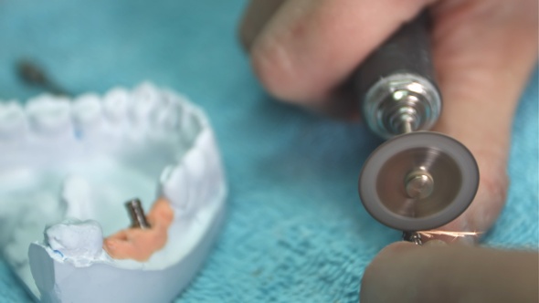 Dentist shows model of dental prosthesis with implant