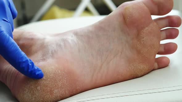 Human Foot With Dry Skin. Dry Skin, Psoriasis Of The Feet. The Skin Is Damaged. Dermatitis, Eczema