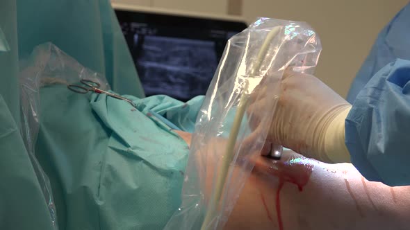 Endovenous laser ablation (EVLA) is a commonly used and very effective minimally invasive therapy to alt