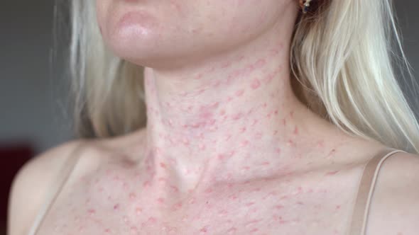 Papules After Beauty Injections on the Face