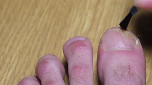 Applying Healing Oil on the Nail to Strengthen the Nail Plate and Aging Nail Fungus alt