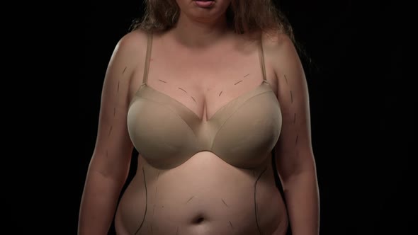 Unrecognizable Obese Caucasian Woman with Plastic Surgery Marks on Body Looking at Scissors in Hand alt