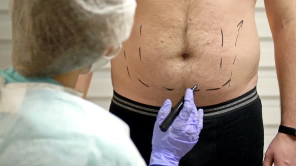 Plastic Surgeon Prepares Patient Liposuction Surgery alt