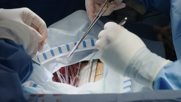 Surgeons working during open heart surgery, close up on hands and instruments. alt