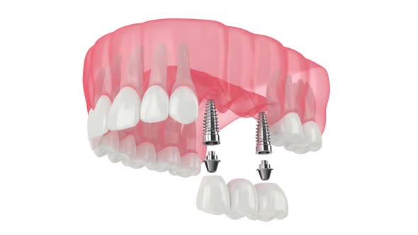Upper jaw with implants supporting dental bridge