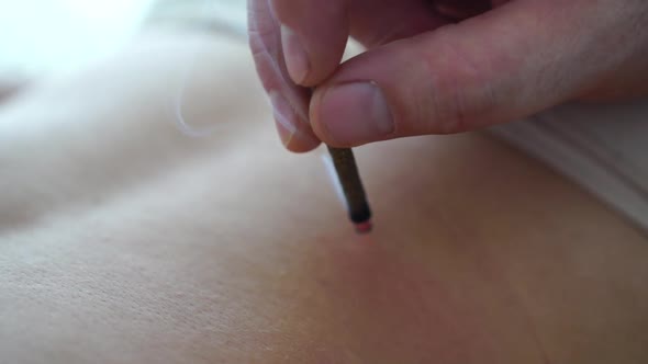 Therapist Performing Moxibustion Procedure at Health Center alt