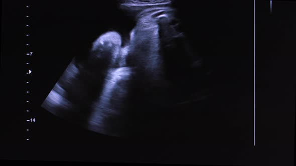 Image of Unborn Baby in Womb on Ultrasound Screen alt