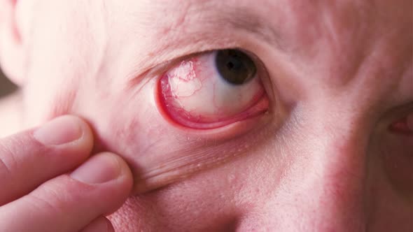 Close Up of Man's Face Showing Red Bloodshot Eye