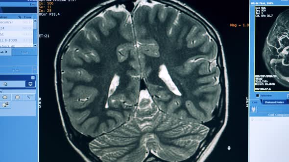 Image of a Human Brain in the MRI Interface, Stock Footage | VideoHive