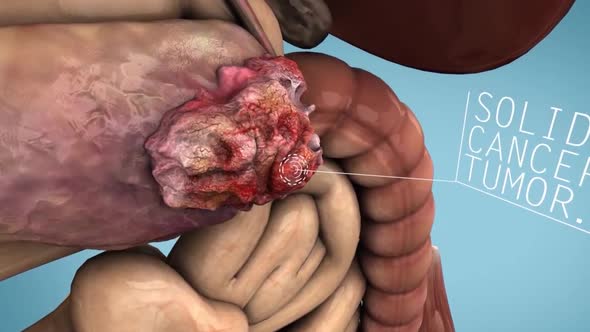pancreatic cancer  medical animation alt