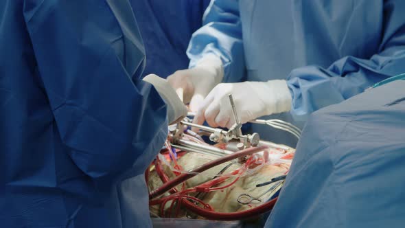 Surgeons working during open heart surgery, close up on hands and instruments. alt