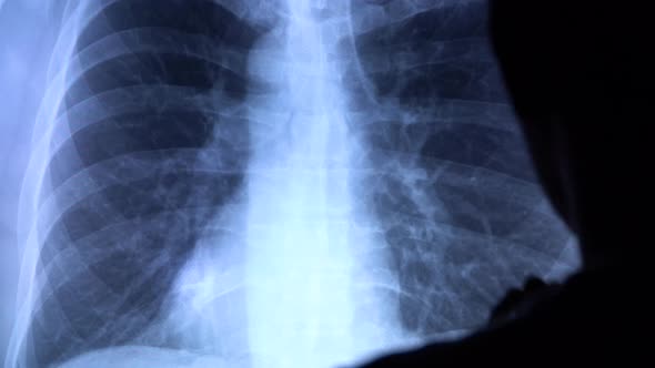 A doctor with a pen checks a medical x-ray of lungs with pneumonia on a big sensor screen.