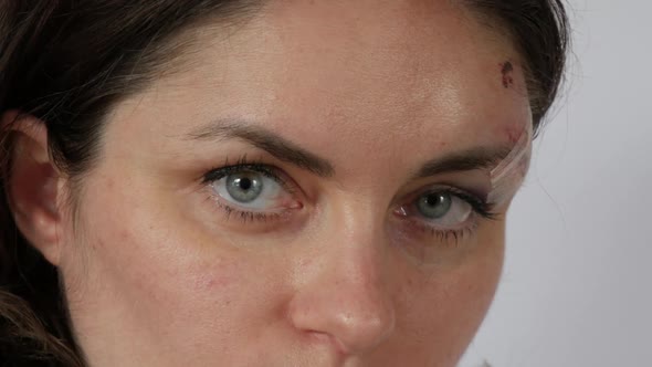 Large Real Bruise Hematoma Under the Eye of a Young Woman Fresh Purple Bruise and Scratches on the alt