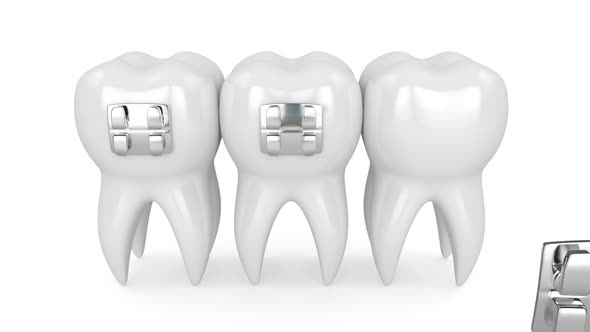 Teeth with dental orthodontic braces