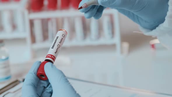 The Doctor Holds Hand Blood Sample Positive with Adenovirus alt