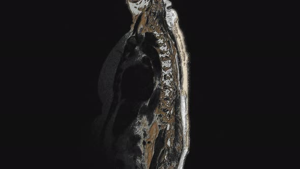 Postoperative Bulk Multicolored MRI of Female Organs for the Detection of Metastases alt