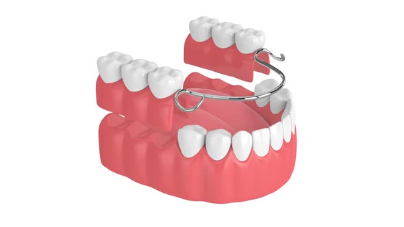 Removable partial denture isolated over white background