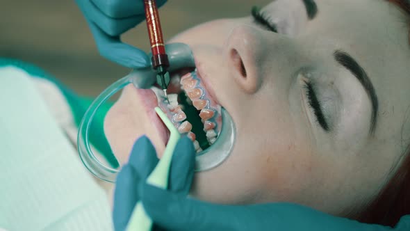 Application of Bleaching Gel for Procedure of Teeth Whitening alt
