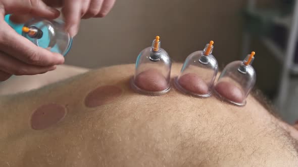 Therapist Giving Vacuum Cupping Therapy To Man's Back in the Clinic alt