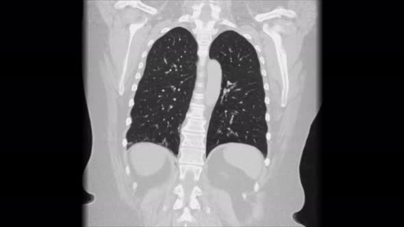 MRI of the Lungs and Bronchi, Diagnosis of Viral Respiratory Disease alt