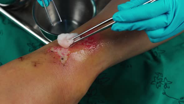 close up doctor cleaning wound on the leg by alcohol, Injuries from falling
