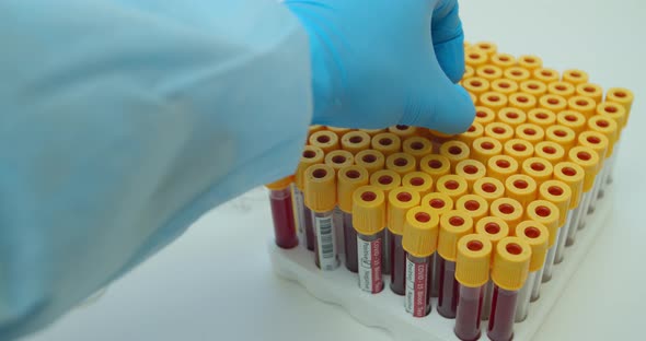 Researcher Hand Showing Tube, Positive Result of Blood Test for Coronavirus, Covid-2. alt